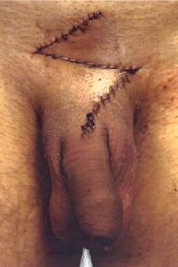 Postoperatieve uiterlijk na penisverlenging