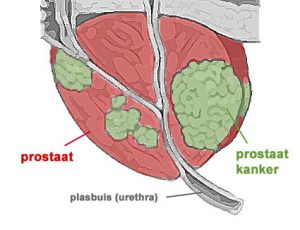 seks en prostaatkanker