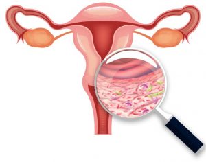bacteriële vaginose