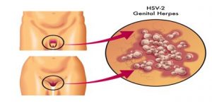 verschijnselen van herpes