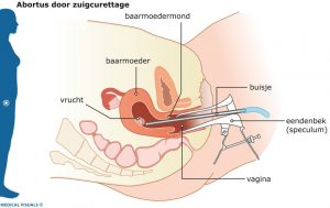 zuigcurettage